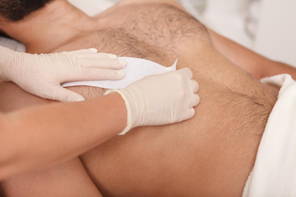 epilation